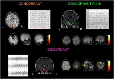 Temporal Lobe Spikes Affect Distant Intrinsic Connectivity Networks